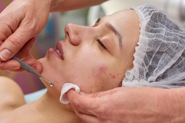 Acne With Extraction & High Frequency Facial OliviasHeritage.com 